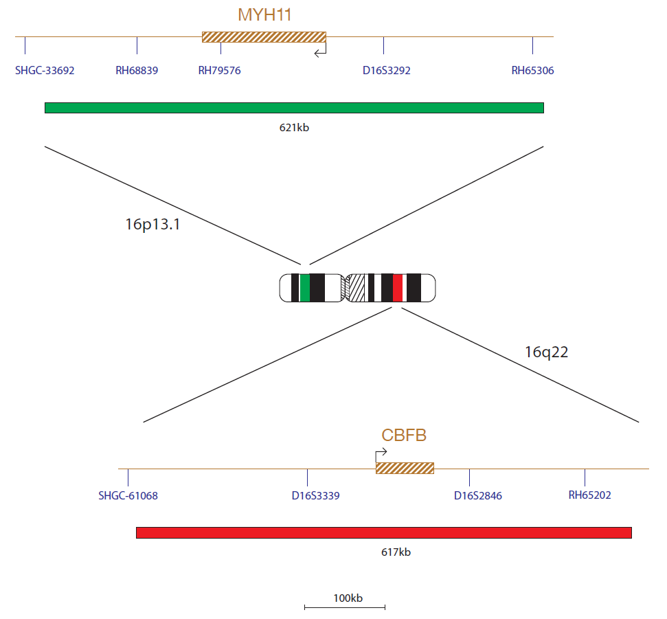 CBFB/MYH11 (INV16) Translocation